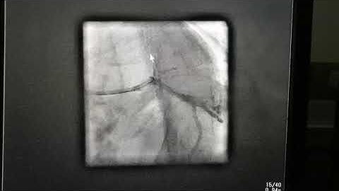 Ostial CTO Lad Angioplasty with dominant LCX ||Dr Muhammad Shahid Sarwar Hasnani