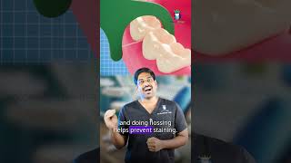 What to do if composite fillings stain? - Denta Kings