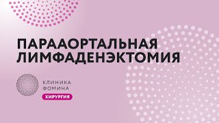 парааортальная лимфаденэктомия // поясничная лимфодиссекция // лапароскопическая лимфодиссекция