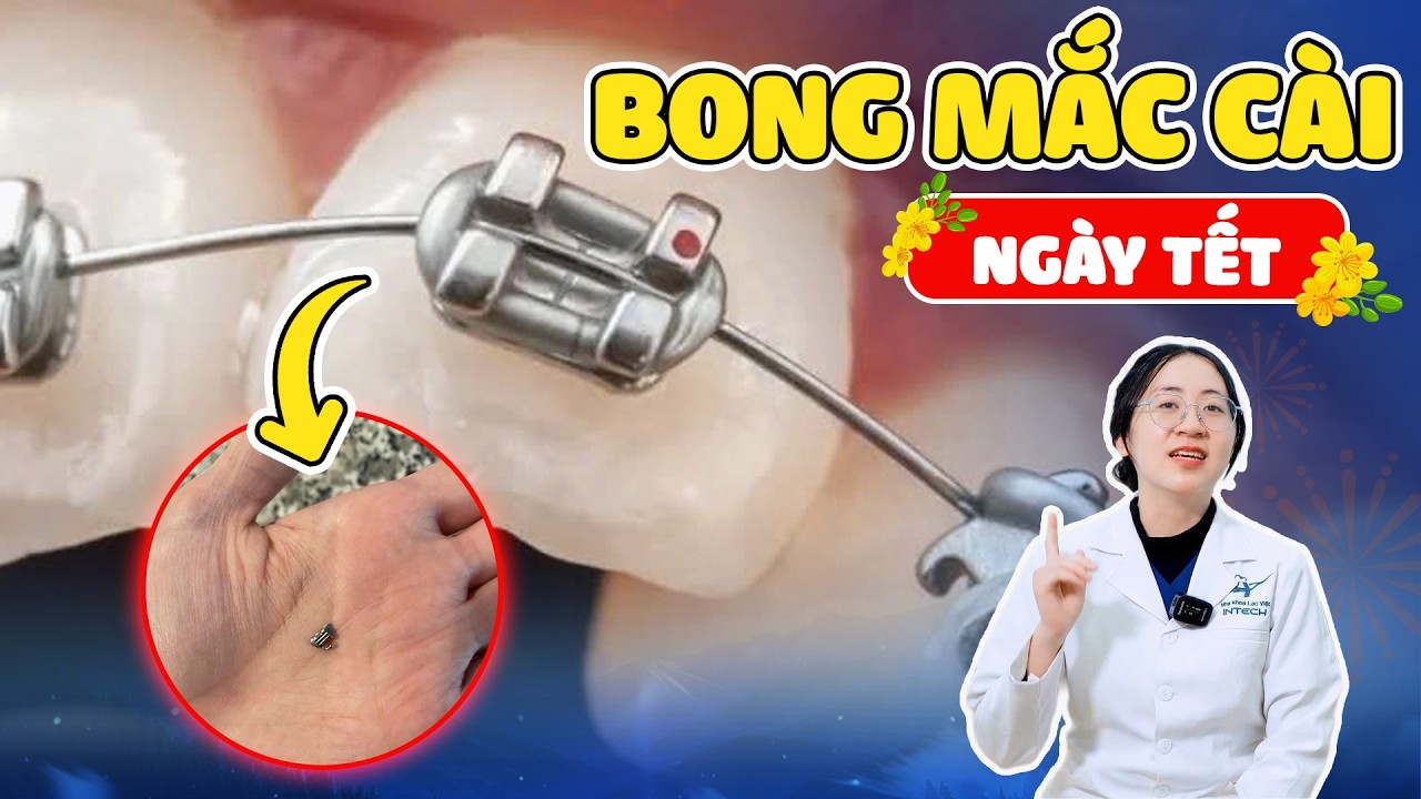 Bong Mắc Cài Và 3 Sự Cố Niềng Răng Dịp Tết - Cách Xử Lý An Toàn