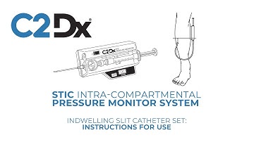 Measure Compartment Pressure - STIC (Indwelling Method) Instructions