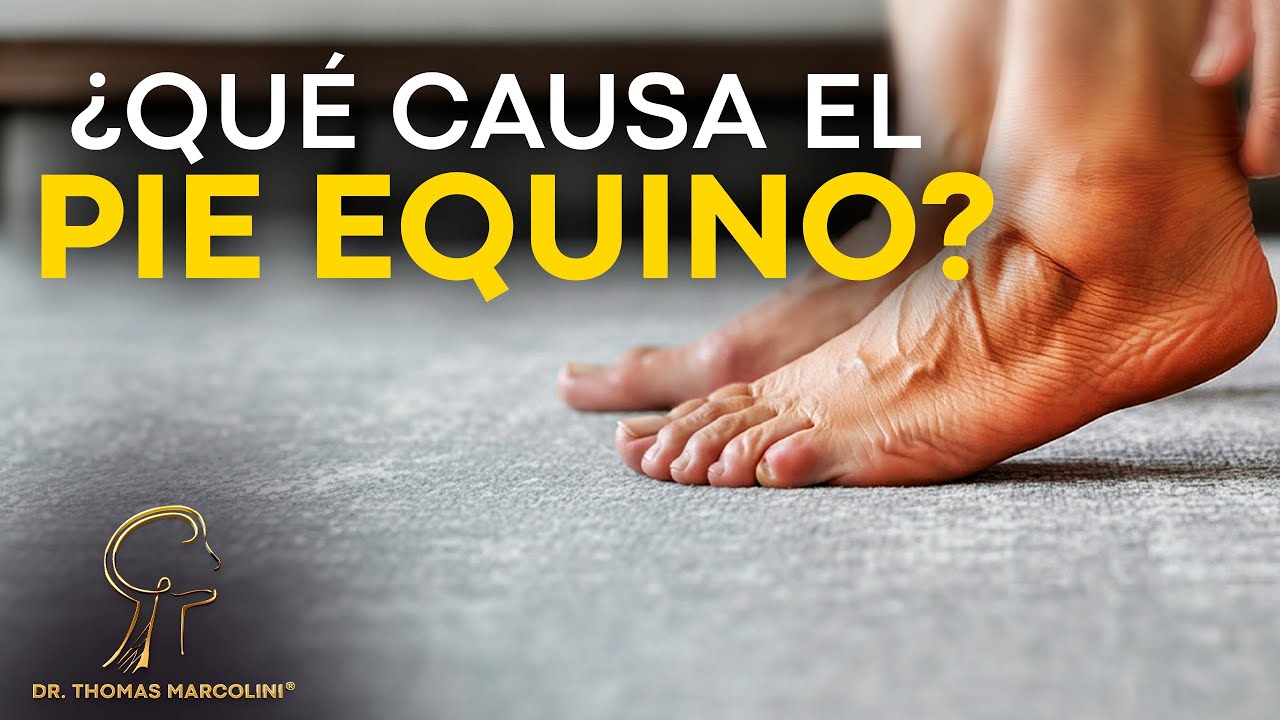 ¡Descubre Cómo Prevenir y Cuándo Tratar el Pie Equino!