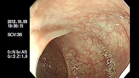 Cắt đốt polyp đại tràng - Endoscopic Polypectomy