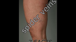 Spider Veins   7 Facts About Leg Spider Veins You Must Know