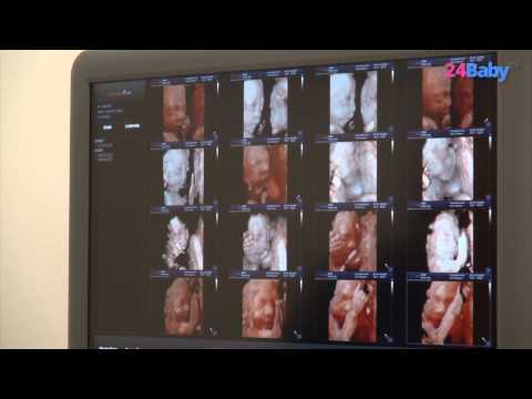 Video: Verschil Tussen 3D En 4D Echografie