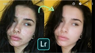 LIGHTROOM Mobile Tutorial - How to remove pimples/acne | Clear face by LIGHTROOM Mobile