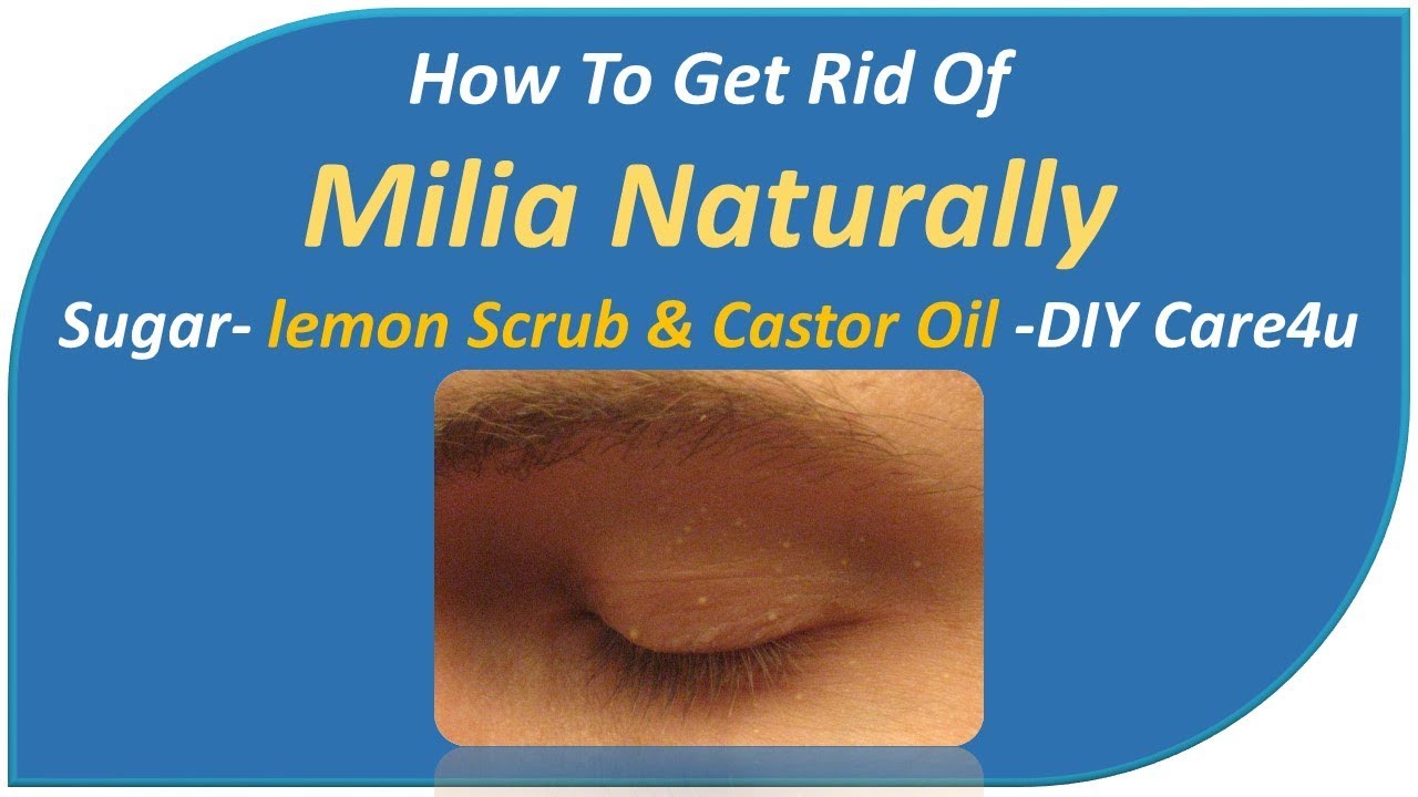 How To Get Rid Of Milia Naturally SugarLemon Scrub & Castor Oil DIY