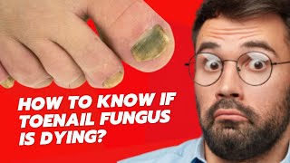 HOW TO KNOW IF TOENAIL FUNGUS IS DYING? (TOENAIL FUNGUS TREATMENT)