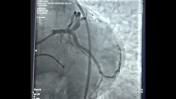 Left main LCX LAD bifurcation PTCA by TAP technique in ACS