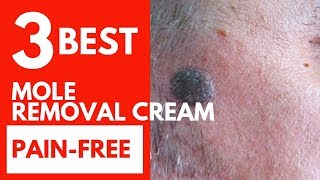 Top 3 Best Mole Removal Cream-Surgical Alternative And Pain-Free