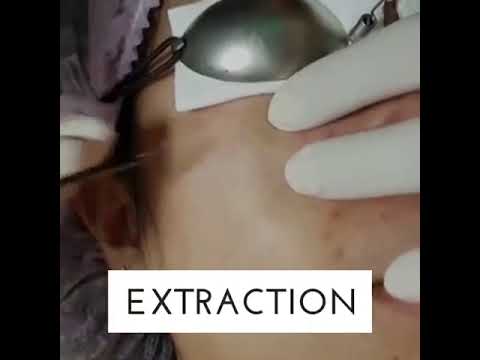 Acne Extraction at My Skin Clinic Lahore