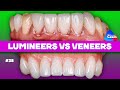 Lumineers VS Veneers | BG Dental Cases #38