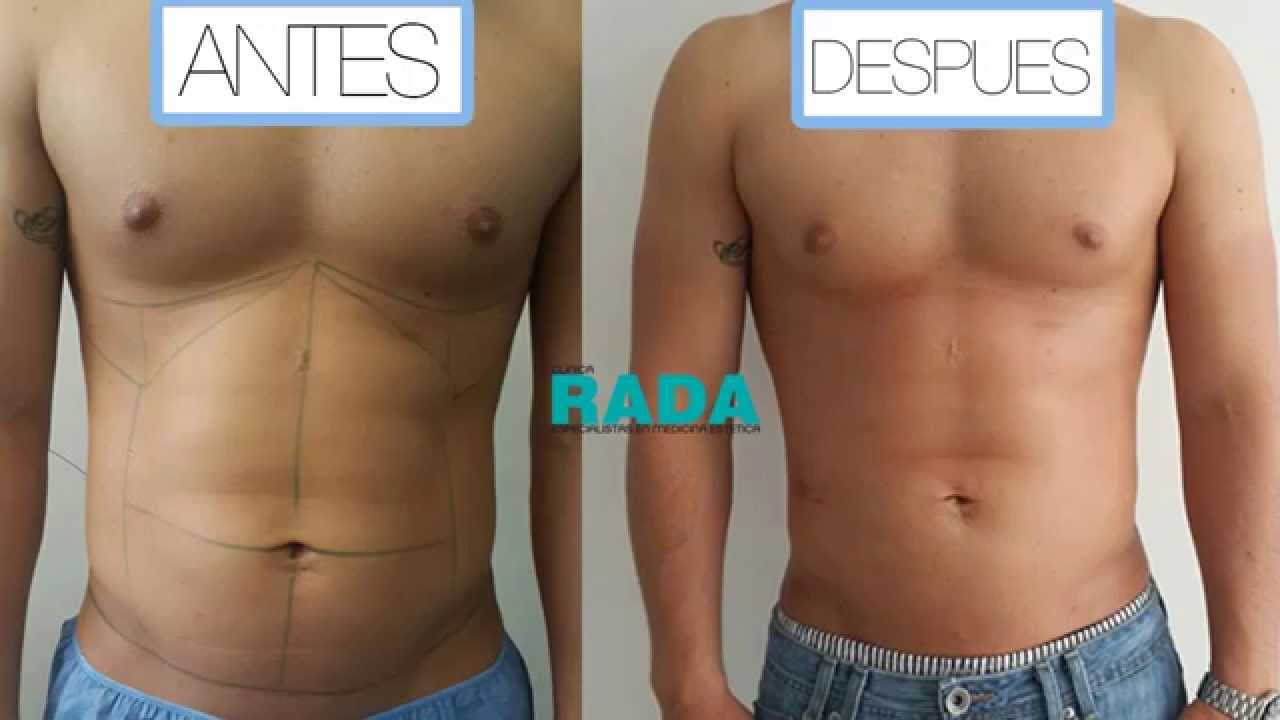 Lipolisis láser YouTube