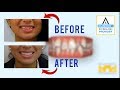 Invisalign Before and After: Crowded Teeth