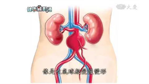 腹主動脈瘤 死亡率高治療趁早 - 天天要聞