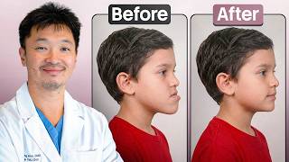 Understanding & Treating Underbites with Jaw Functional Orthopedics -Priya Mistry, DDS (the TMJ doc)
**Can Jaw Functional Orthopedics Correct an Underbite Without Surgery?**
Did you know that an underbite is often much more than a problem with the teeth? In many children, an underbite is actually the result of how the jaws are growing—not just where the teeth are positioned. In this video, Dr. Priya Mistry, The TMJ Doc, explains how **Jaw Functional Orthopedics (JFO)** can guide jaw growth during childhood to help correct many skeletal underbites while children are still growing.
Youll learn the difference between **dental and skeletal underbites**, why mouth breathing, tongue posture, swallowing, and facial growth all play an important role, and why early intervention can make such a significant difference. Dr. Mistry also demonstrates how the **SN3 appliance with an Eschler arch** works to encourage proper tongue posture, stimulate forward growth of the upper jaw, and guide healthy jaw development using your childs own natural growth.
In this video youll discover:
• What causes an underbite
• Dental vs. skeletal underbites
• How tongue posture influences jaw growth
• The connection between mouth breathing and facial development
• Why early treatment matters
• How Jaw Functional Orthopedics works
• The SN3 appliance and Eschler arch explained
• Before-and-after patient results
• When treatment may help avoid jaw surgery later in life
If youre a parent concerned about your childs bite, or a dentist interested in functional orthopedic treatment, this video will help you better understand how growth guidance can create lasting changes.
📍Schedule a consultation:
https://thetmjdoc.com
👍 If you found this video helpful, please Like, Subscribe, and turn on notifications so you never miss future videos about TMJ disorders, airway health, jaw development, and pediatric functional orthopedics.
#Underbite #JawFunctionalOrthopedics #FunctionalOrthodontics #AirwayDentistry #PediatricDentistry #TMJ #TMJDoctor #FacialGrowth #ChildOrthodontics #EarlyOrthodonticTreatment #ClassIIIMalocclusion #MouthBreathing #TonguePosture #JawDevelopment #TheTMJDoc
Other links:
🌐 Website: https://tmjdentaldoc.com/
📘 Facebook: https://www.facebook.com/priya.mistry.942145
📸 Instagram: https://www.instagram.com/the_tmj_doc
🎵 TikTok: https://www.tiktok.com/@the_tmj_doc
🎙️ Podcast Links:
🎧 Audio Platform Linktree: https://unclenched.captivate.fm/listen
🎥 YouTube Podcast Channel: https://www.youtube.com/@UnclenchedPod
🍏 Apple Podcasts: https://podcasts.apple.com/us/podcast/...
🎵 Spotify: https://open.spotify.com/show/4FGwUKT...
#Bruxism #TMJD #TeethGrinding #TeethClenching #JawPain #SleepApnea #DrPriyaMistry Understanding & Treating Underbites with Jaw Functional Orthopedics -Priya Mistry, DDS (the TMJ doc)