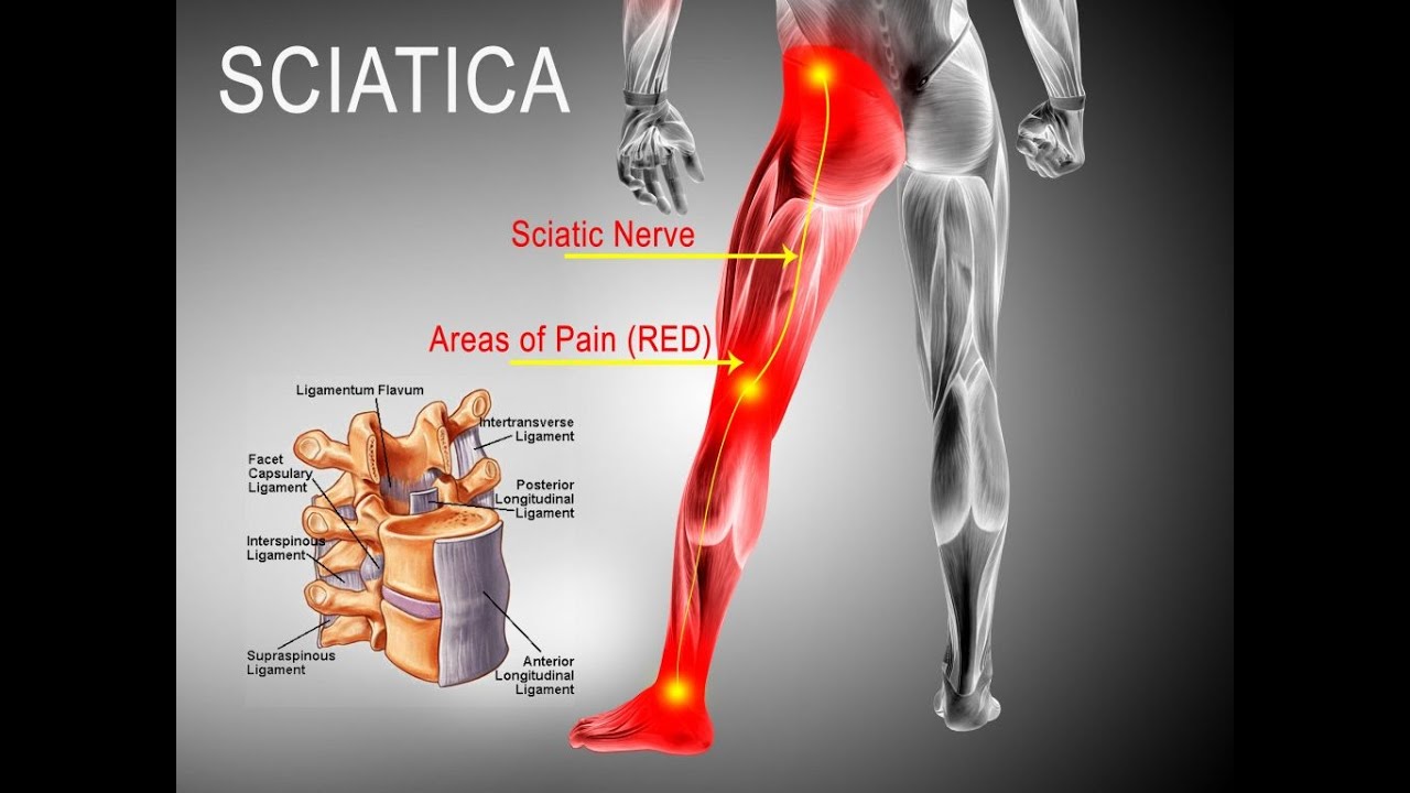 Sciatica Causes Symptoms Diagnosis Treatment Anatomy YouTube