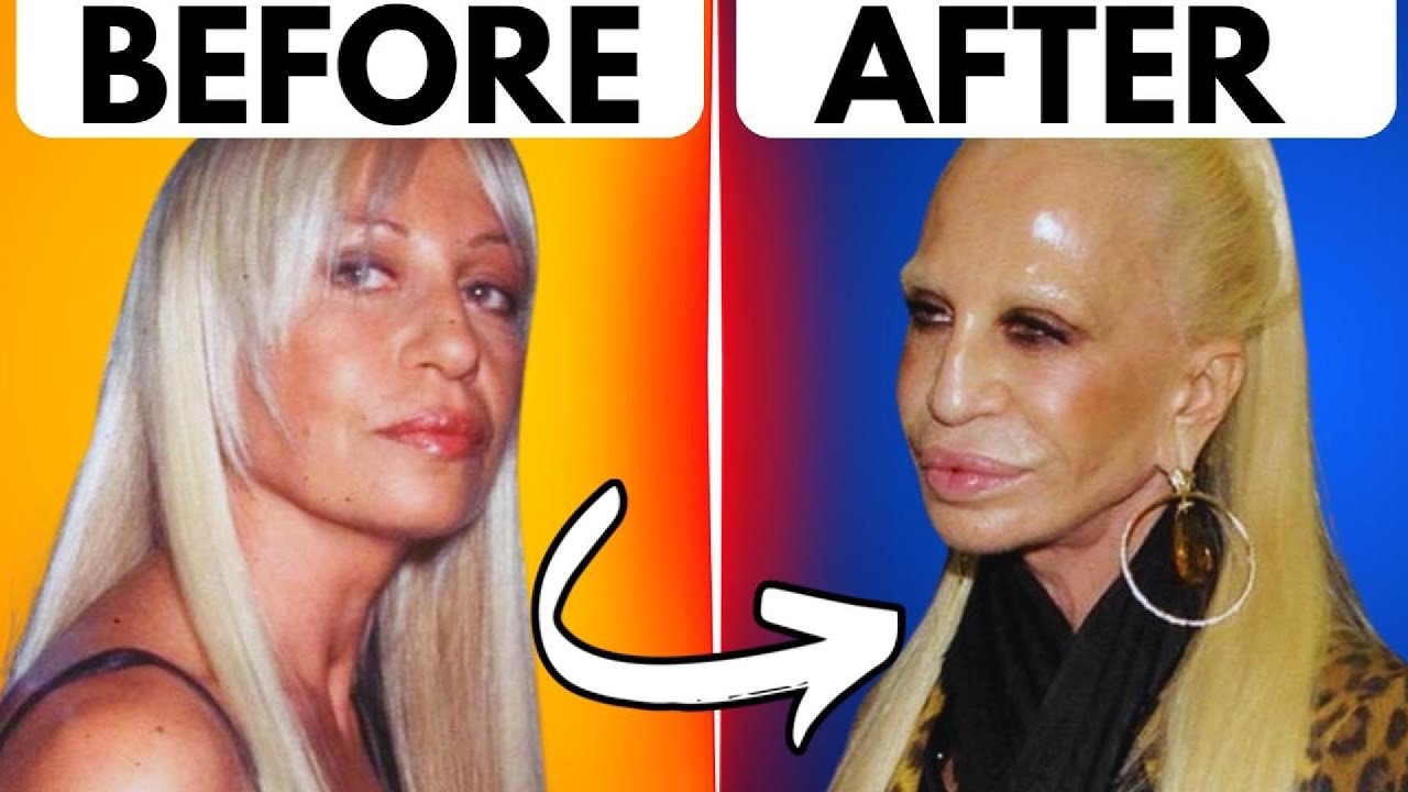 Discover How Extreme Plastic Surgeries Changed These Celebrities ...