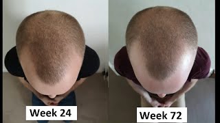 Scalp Massage For Hair Loss (48 Week Experiment)