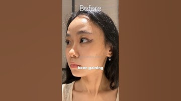 Engene got surgery to look like Jungwon #enhypen #shorts #shortsfeed #shortsviral #kpopnews
