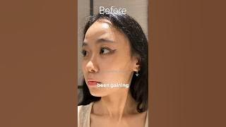 Engene got surgery to look like Jungwon #enhypen #shorts #shortsfeed #shortsviral #kpopnews
