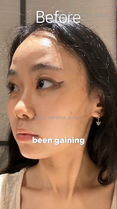 Engene got surgery to look like Jungwon #enhypen #shorts #shortsfeed #shortsviral #kpopnews