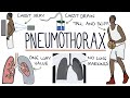 Pneumothorax