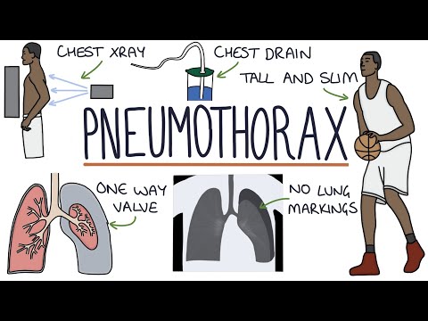 Video: Pneumothorax