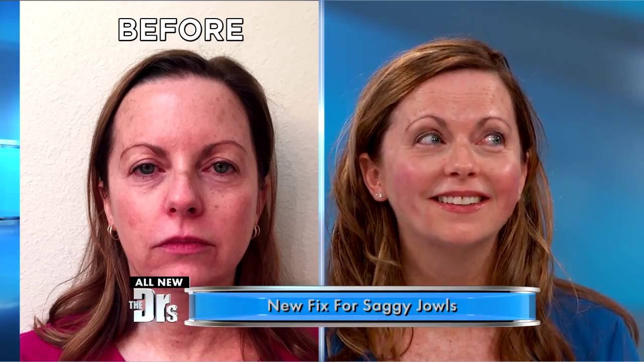 As seen in The Doctors: NovaLift Results