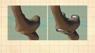 20th Year of Medial Pivot Video 1 2