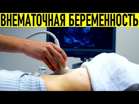 ВНЕМАТОЧНАЯ БЕРЕМЕННОСТЬ | Признаки внематочной беременности на ранних стадиях