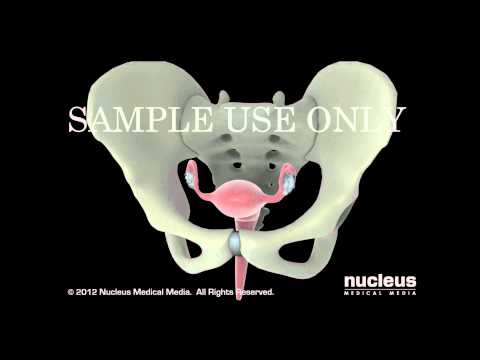 Vídeo: Cuello Uterino Friable: Síntomas, Causas Y Más