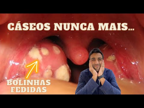 COMO ELIMINAR DEFINITIVAMENTE OS CASEOS DA AMÍGDALA (SEM CIRURGIA)