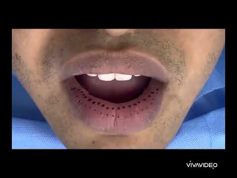Lip Reduction Surgery عملية تصغير حجم الشفاه