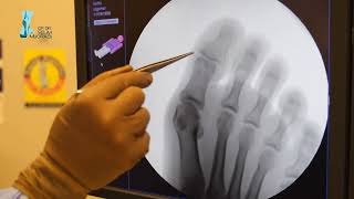 Baş Parmak Çikintisi Ameli̇yati (Halluks Valgus) Op. Dr. Selim Muğrabi