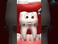 These Teeth Just Want to Be Bros! 🦷👬 How Braces Actually Work #Braces, #Teeth, #SmileTransformation