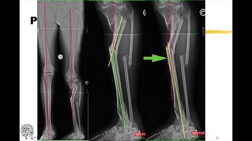 Ortho-SUV - 6 axis deformity correction