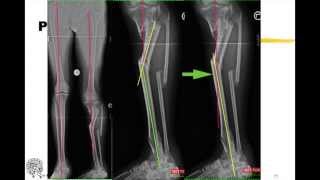 Ortho-SUV - 6 axis deformity correction