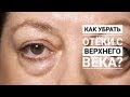 Как снять отек с верхнего века?