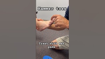 Treating hammer toes with a orthotic and met pads is my first line of treatment. #physiotherapy ￼￼