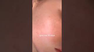 10 days skin transformation challenge #koreanskincare #skincare #skincareroutine #skin