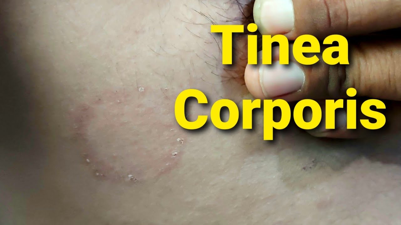 Tinea Coporis | Fungal Infection - YouTube
