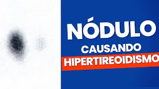 Doença De Plummer Nódulo Causando Hipertireoidismo