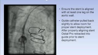 OstialPRO® Stent Positioning System Subclavian Case Study