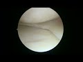 How do you repair a medial meniscus  1523 js