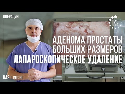 Аденома простаты больших размеров. Лапароскопическое удаление