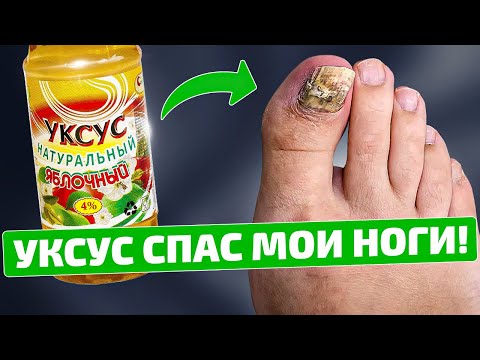 Избавилась от грибка быстро и просто с помощью уксуса!