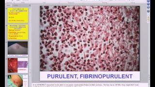 Medical School Pathology, 2013 Season, Session #4: Inflammation