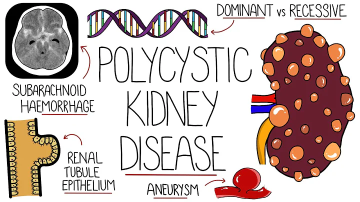 Polycystic Kidney Disease Explained - DayDayNews