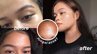 HOW I (finally) GOT RID OF MY ACNE, TINY BUMPS & SCARS / SKIN CARE / TIPS! (WORKS)